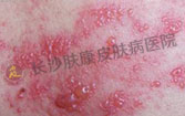 带状疱疹都有什么危害